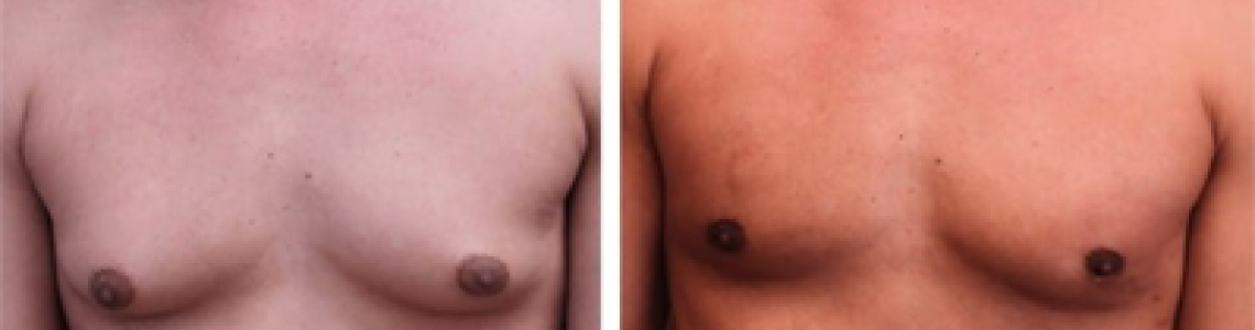 What is Gynecomastia? Why does it happen?