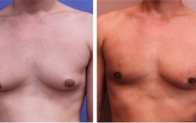 What is Gynecomastia? Why does it happen?