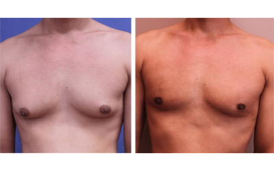 What is Gynecomastia? Why does it happen?